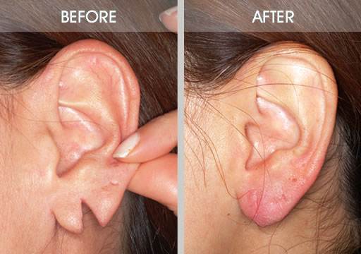 Ears Lobe Repair.jpg